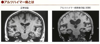 専門学校 琉球リハビリテーション学院 認知症と作業療法